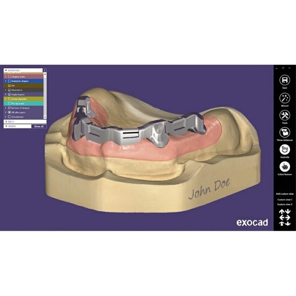 Обновления программного обеспечения для Exocad, модуль - фото 0