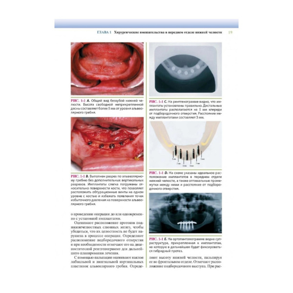 Дентальная имплантология: хирургические аспекты, Блок М. - фото 2