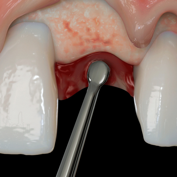 Распатор PM Nanos S, EE2 для туннельной техники, прямой - фото 2