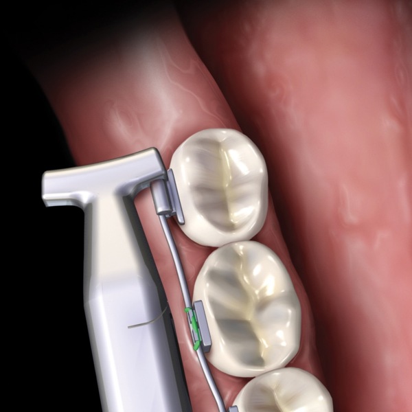 Щипцы для изгибания нитиноловой дуги, тонкий профиль - фото 1