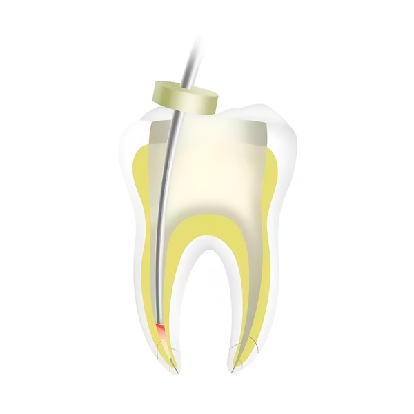 Обтуратор гуттаперчи  Fi-G для пломбирования корневых каналов серии DTE - фото 3