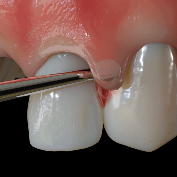 Распатор PM Nanos S, EE2 для туннельной техники, прямой - фото 3