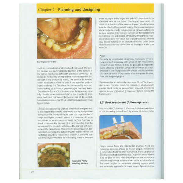 Precision milling and partial denture constructions, Henning Wulfes (английский язык) - фото 7