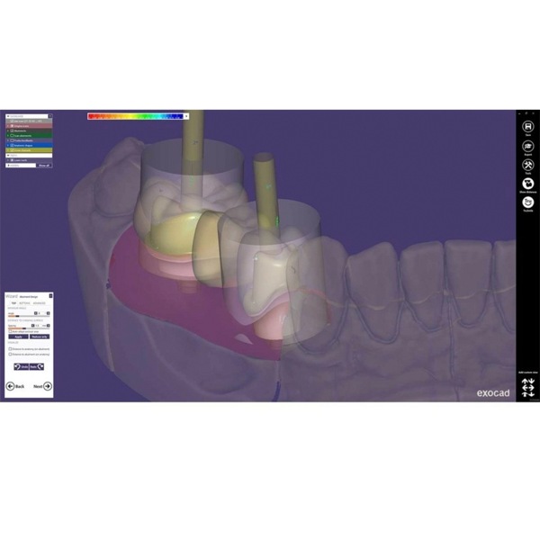 Обновления программного обеспечения для Exocad, модуль абатмента - фото 1