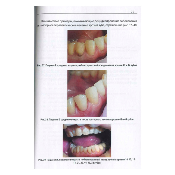 Эрозии зубов, Пихур О.Л., Иорданишвили А.К., Дробкова К.О. - фото 1