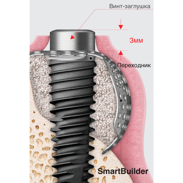 Мембрана титановая OSSTEM OssBuilder OB2, для дефекта одной стенки, P=4.0 мм, BW=8.0 мм, BL=7.0 мм, BD=5.5 мм - фото 1