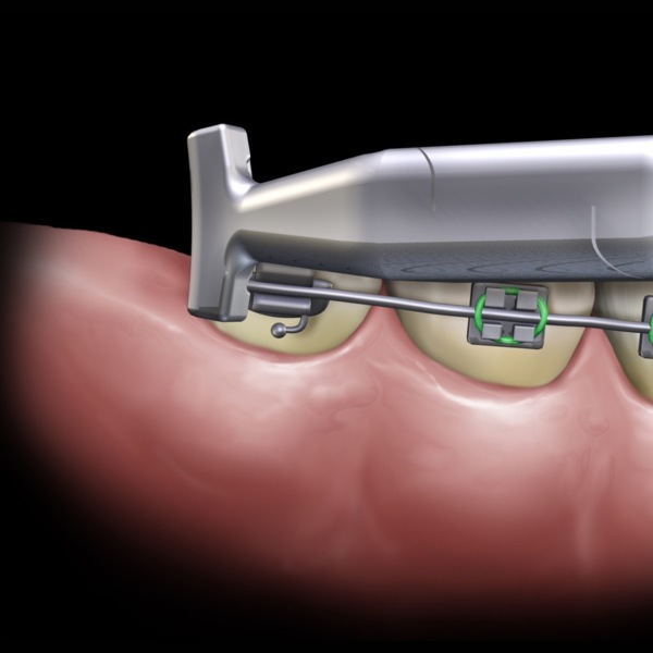 Щипцы для изгибания нитиноловой дуги, тонкий профиль - фото 2