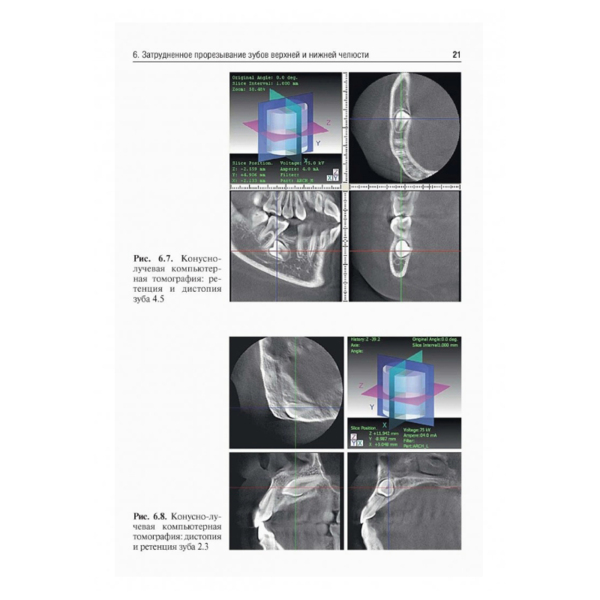 Болезни прорезывания зубов, Э.А. Базикян - фото 3