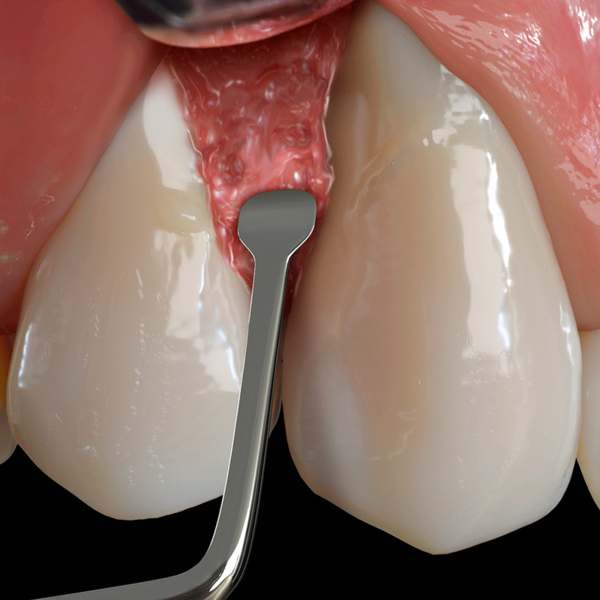 Распатор PM Nanos A, EE2 для туннельной техники, изогнутый - фото 2