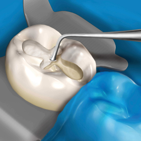Плаггер-штопфер Hu-Friedy Novatech №11, двусторонний, для внесения и уплотнения базовых и прокладочных материалов, ручка №41, сталь, 1 шт - фото 4