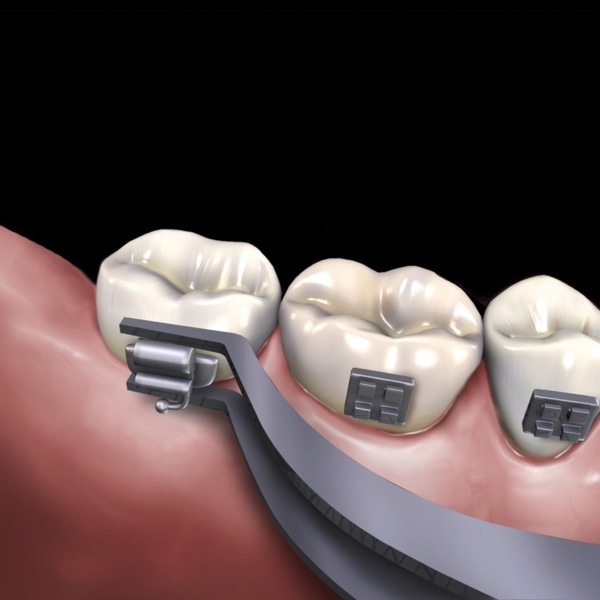 Пинцет ортодонтический Hu-Friedy 678-505, обратный, тонкий профиль, изогнутый, для удержания щёчных трубок - фото 3