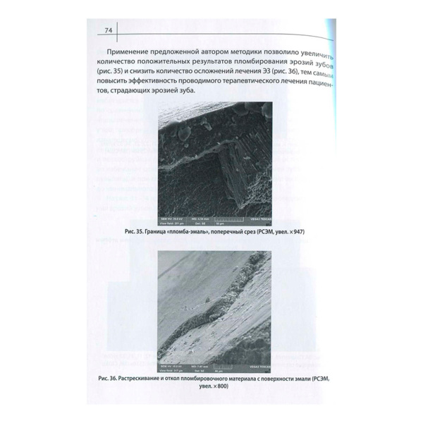 Эрозии зубов, Пихур О.Л., Иорданишвили А.К., Дробкова К.О. - фото 2