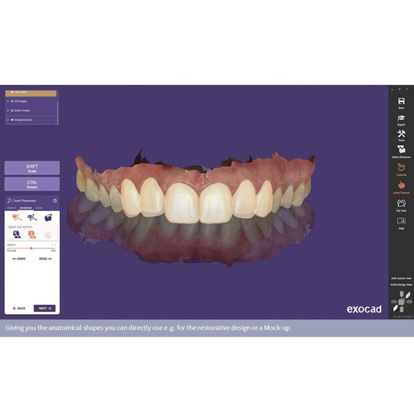 Обновления программного обеспечения для Exocad, модуль Smile Creator - фото 1