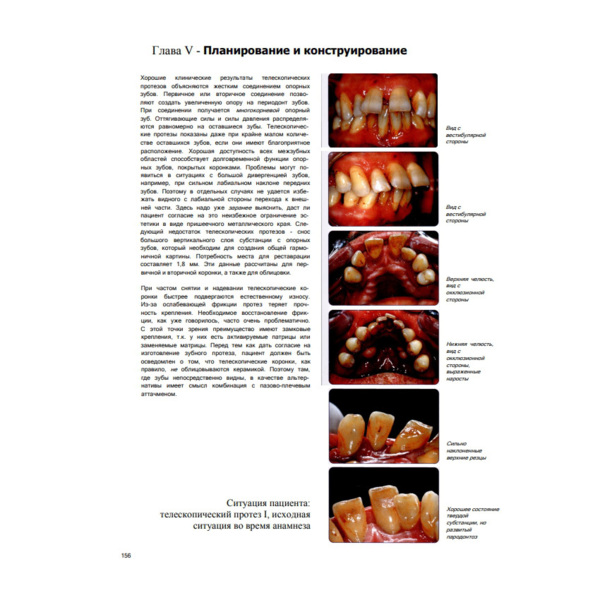 Современные технологии протезирования, Хэннинг Вульфес - фото 10