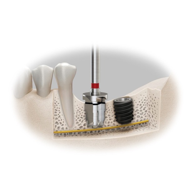 Набор хирургический OSSTEM One485 KIT, для установки имплантатов TS III SA Short, TS IV SA Short - фото 1
