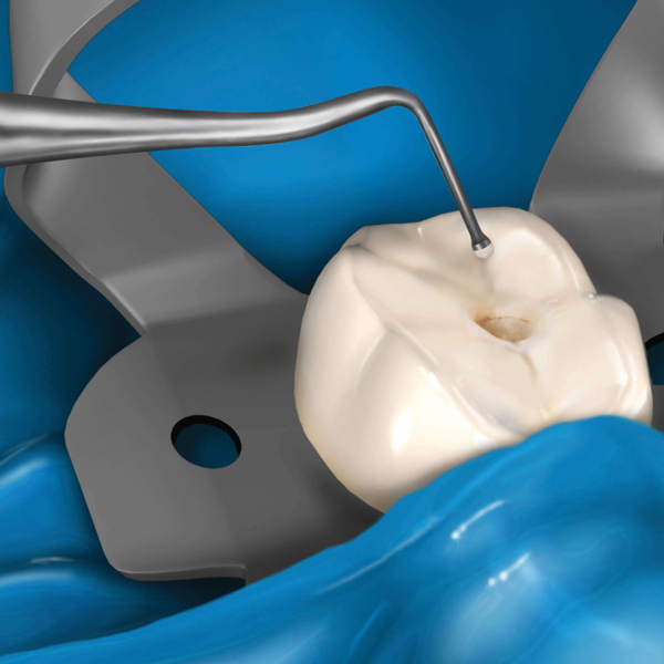Плаггер-штопфер Hu-Friedy Novatech №10, двусторонний, для внесения и уплотнения материалов, ручка №41, сталь, 1 шт - фото 3