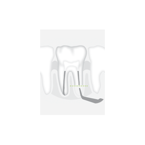 Насадка R2RD - тонкая, с алмазным покрытием для ретроградной обработки корневого канала - фото 1