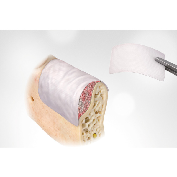 Мембрана коллагеновая OSSTEM OSSMem, резорбируемая, для направленной костной регенерации, мягкая, 15х20 мм, 1 шт - фото 2