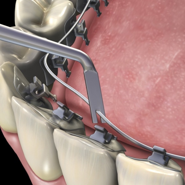 Инструмент для работы с лингвальной лигатурой - фото 3