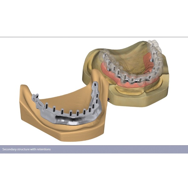 Обновления программного обеспечения для Exocad, модуль балок - фото 2