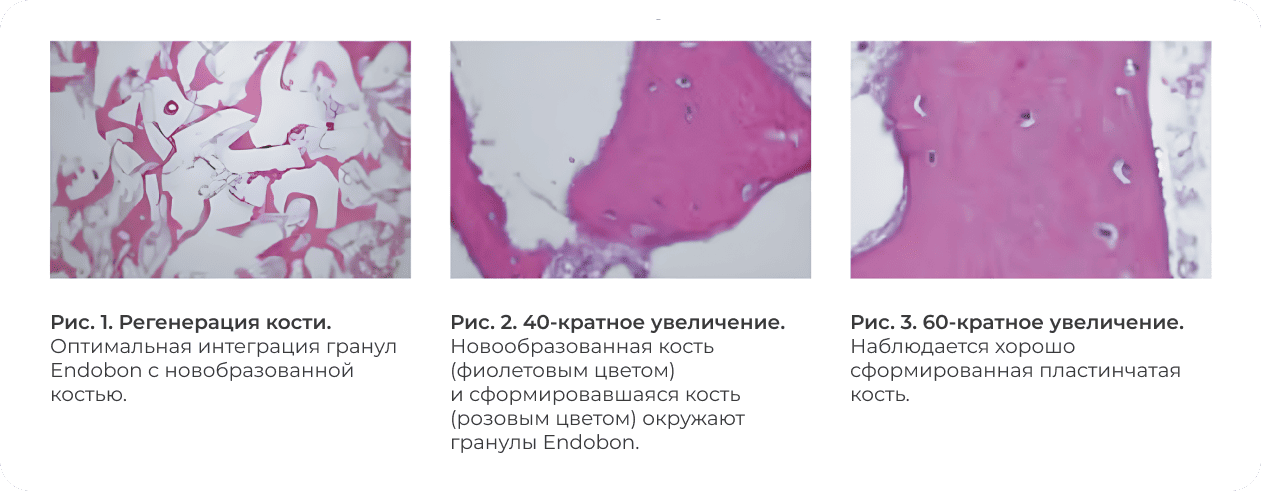 интеграция гранул Biomet 3i Endobon