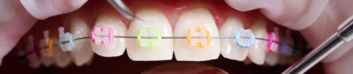 Разновидности брекетов: материалы, эстетика и системы крепления