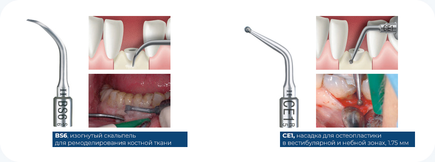 Nabor_hirurgicheskij_Acteon_Crown1