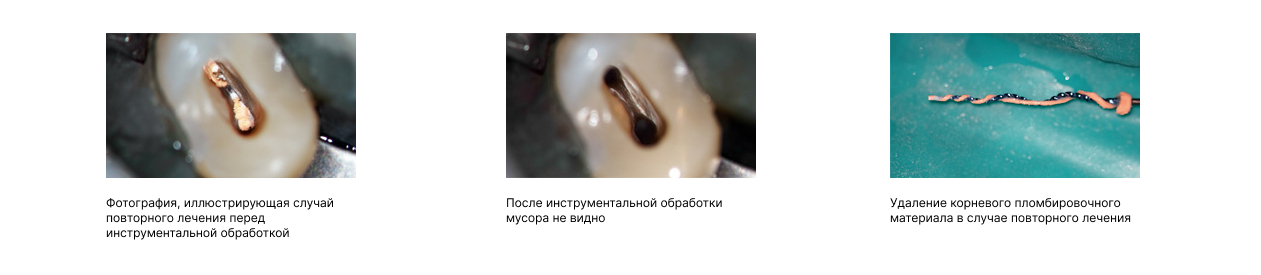 XP-endo Retreatment