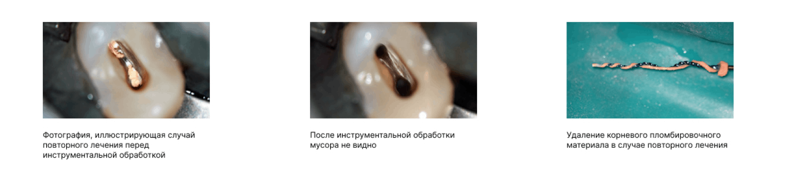 клинический случай набор файлов XP-endo Retreatment