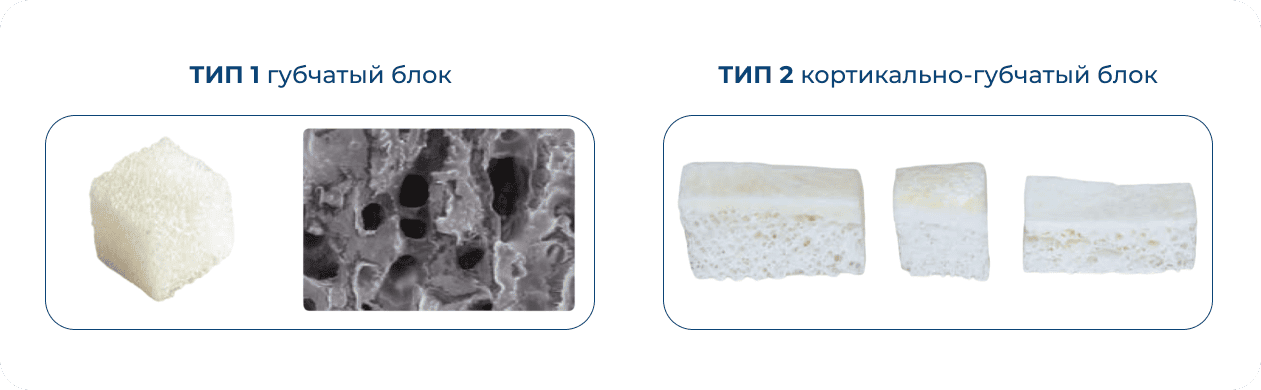 типы костного блока OSSTEM Genesis